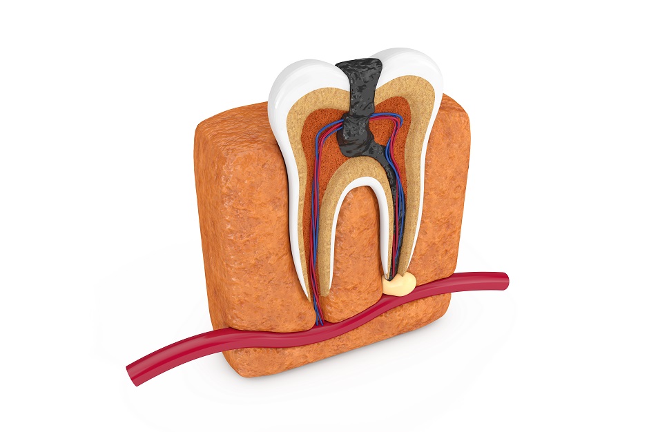 Inside of Decay Tooth