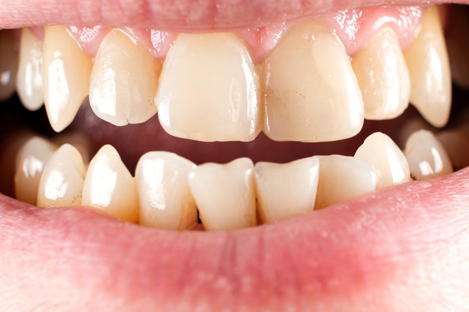 Teeth with tartar and caries, crooked lower foreground incisors.