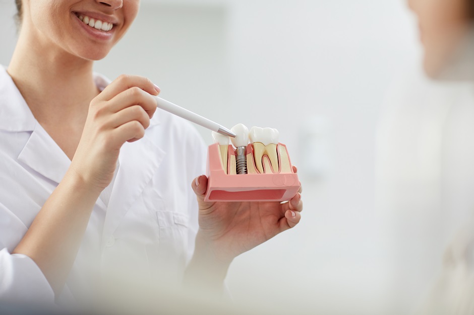 How Long Does a Dental Implant Procedure Take
