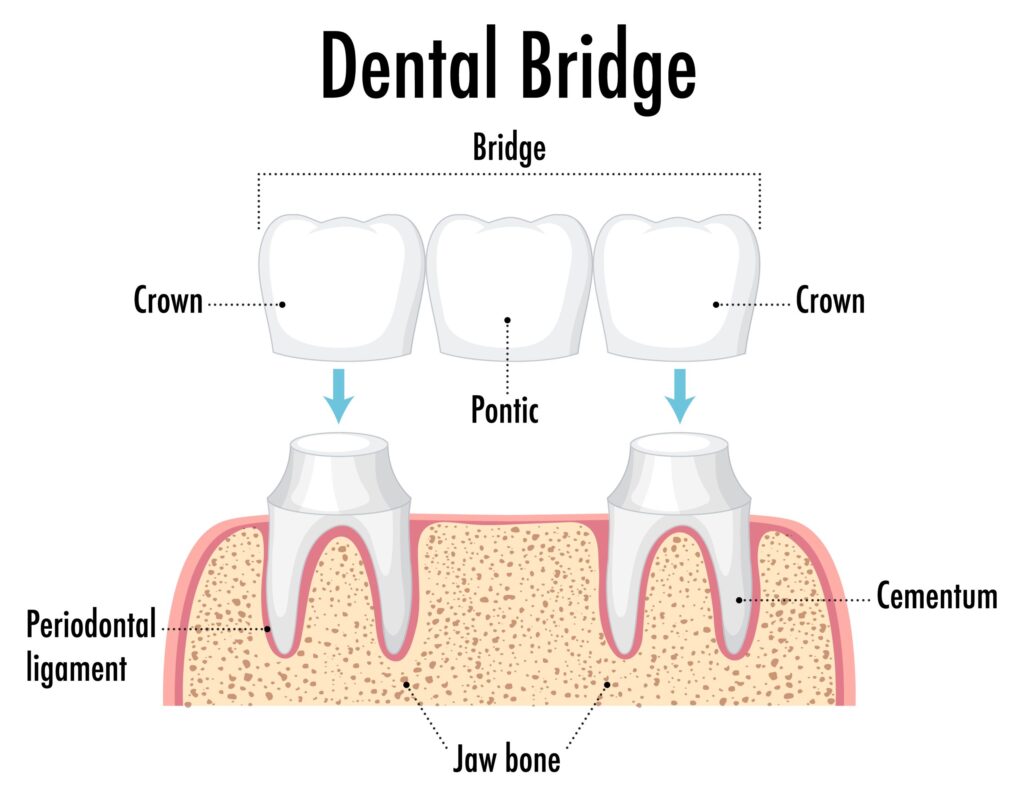 Dental bridges Rutherford College