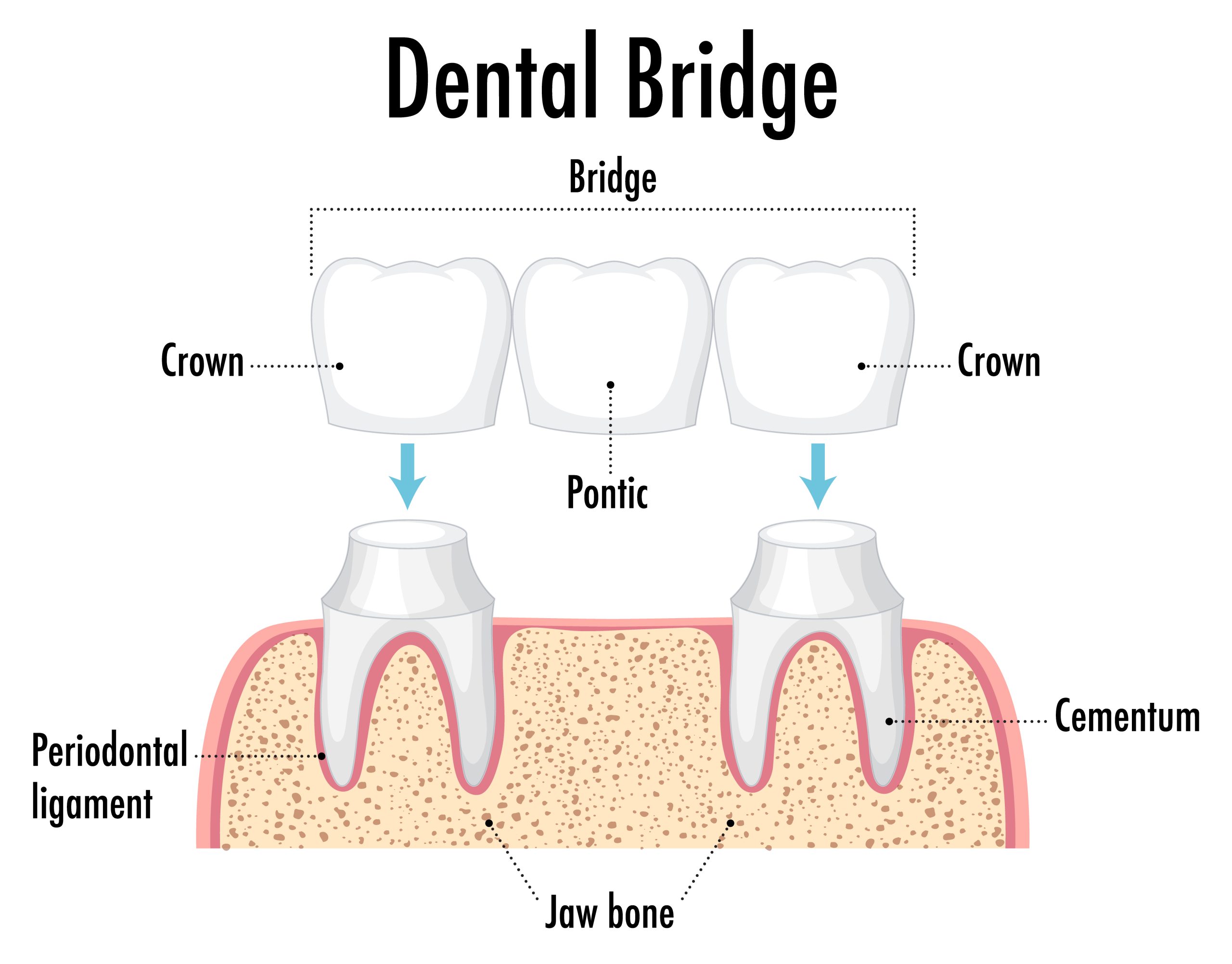 Dental bridges Rutherford College