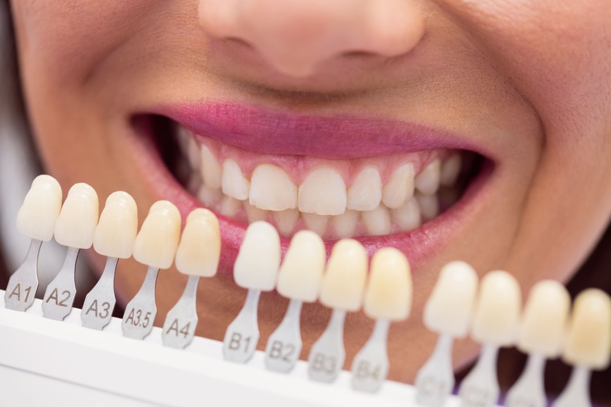 Tooth Colored Fillings
