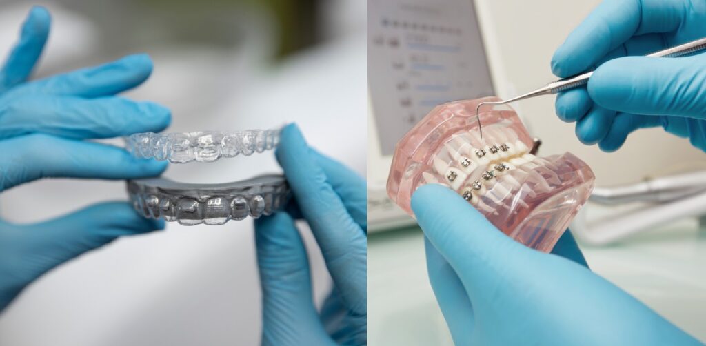 Invisalign vs Braces