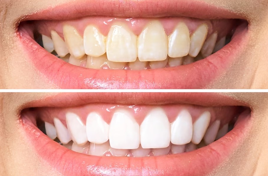 Professional Teeth Cleaning