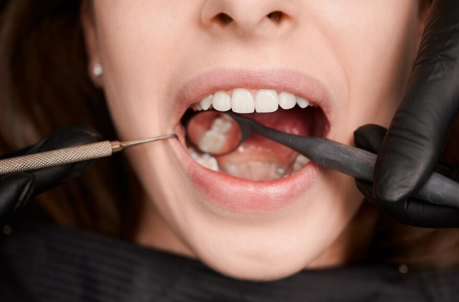 Dental Sealants in Connelly Springs