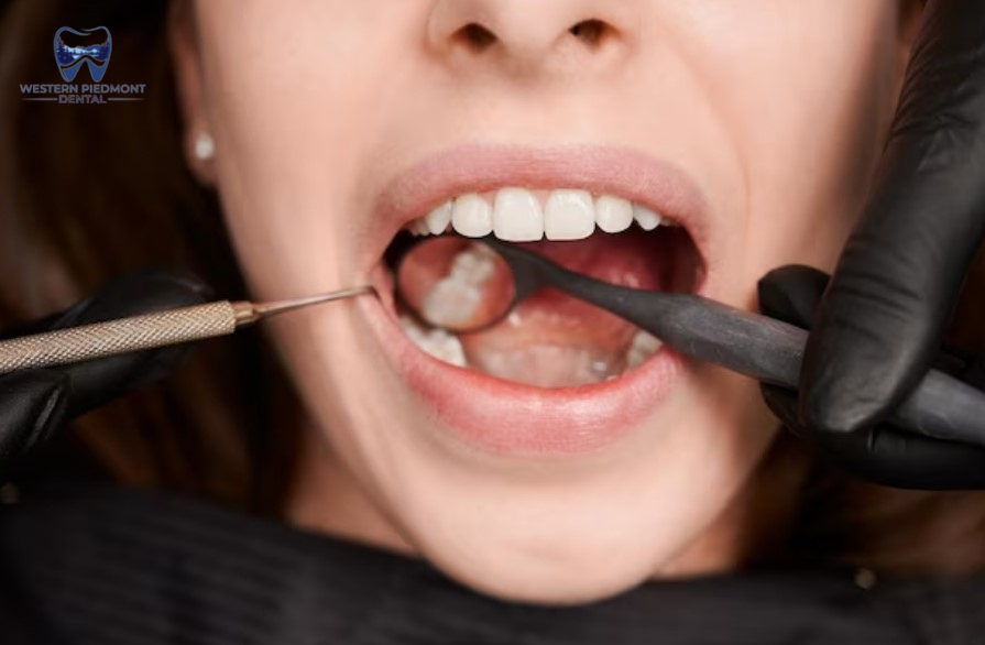 dental sealants