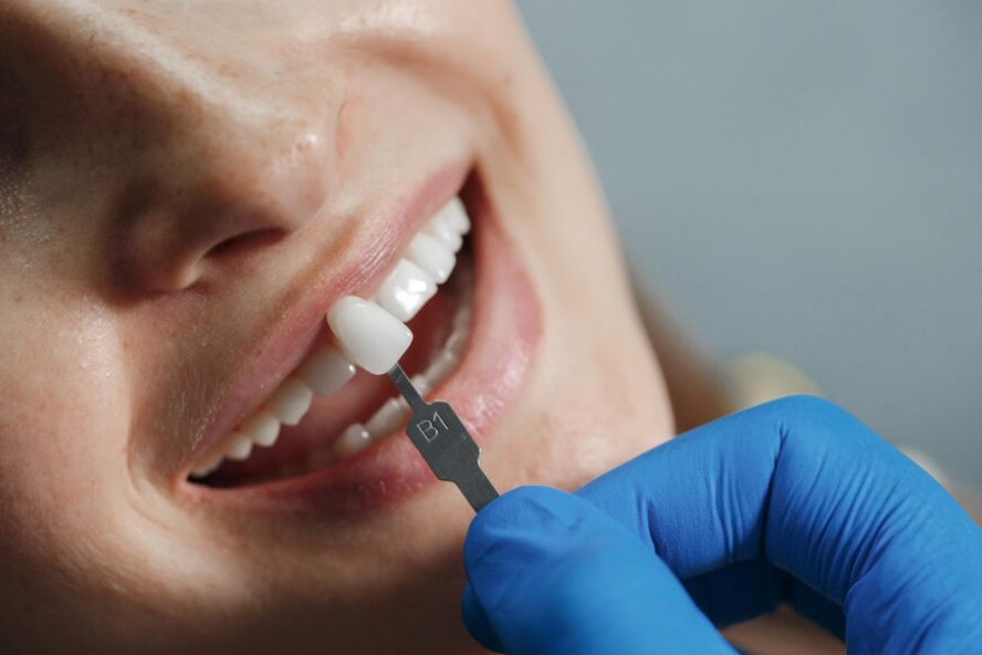 Dental Veneers in Connelly