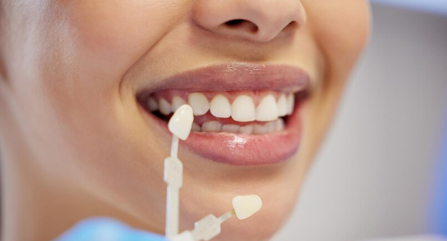Dental veneers