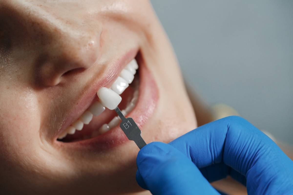 Porcelain Dental Crowns