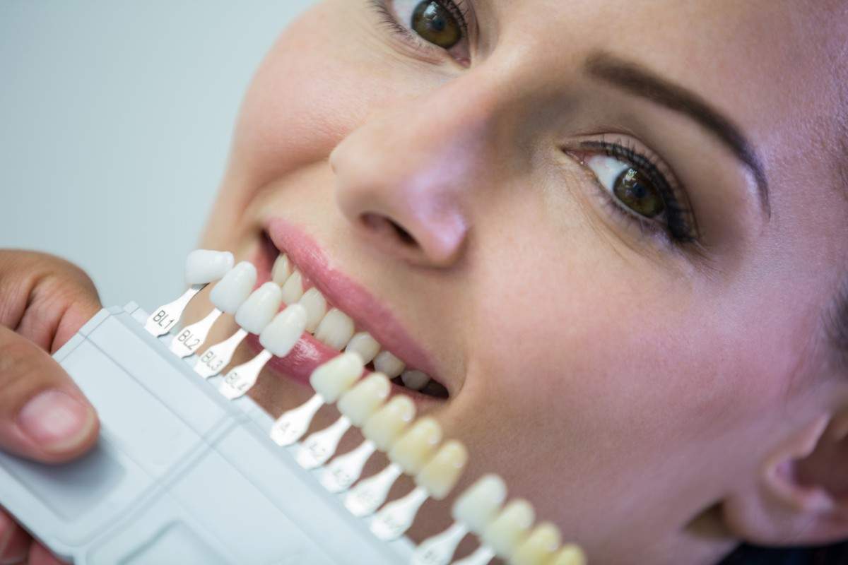 Tooth Colored Filling