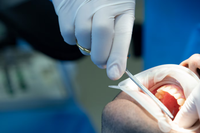 Tooth Extraction