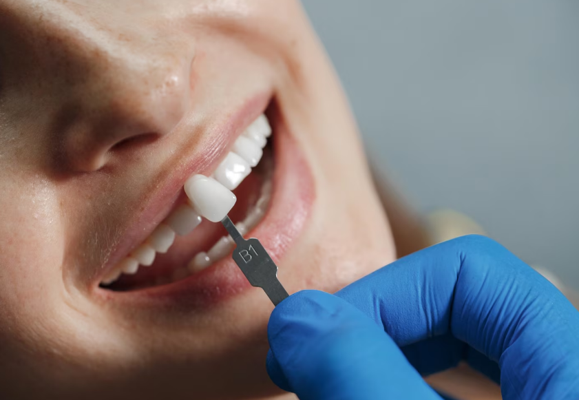 Dental implants