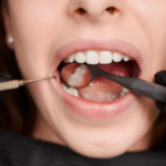 Tooth Extraction