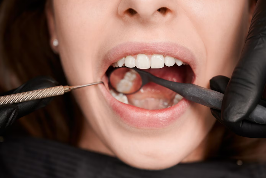 Tooth Extraction